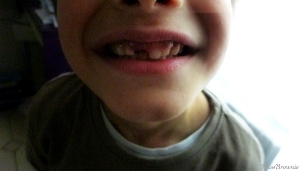 perdre-une-dent-incisive